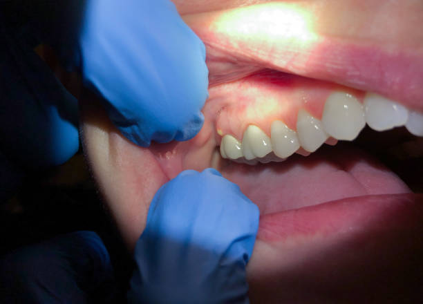 Best Emergency Dentist for Lost Fillings or Crowns in Canastota, NY